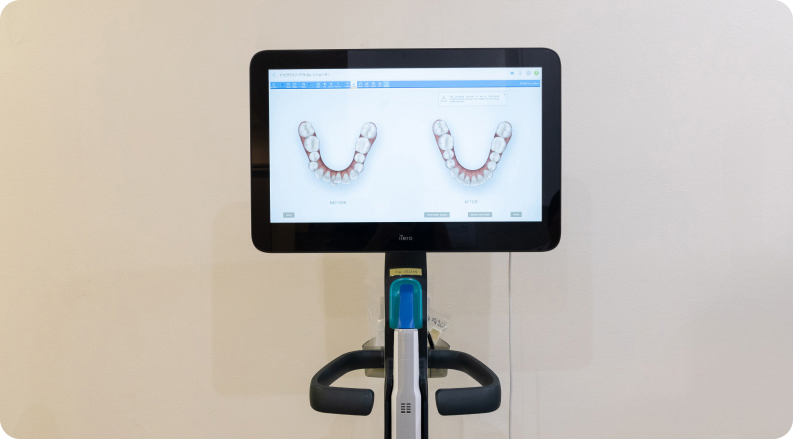 iTeroによる精密なデジタルスキャン